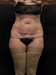 LAL-360 + Avelar Tuck-before