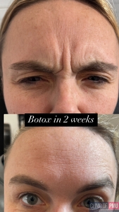 Botox-before