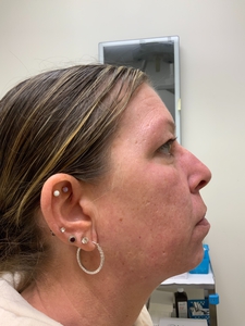 treatment for acne scarring-before