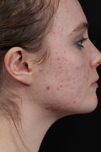 MLP + Profractional + BBL-after