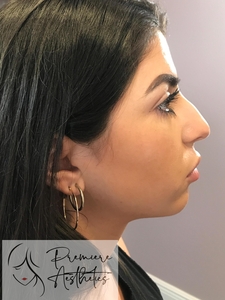 Radiesse Chin-before