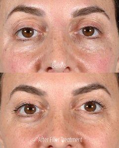 Filler BC B/A-before