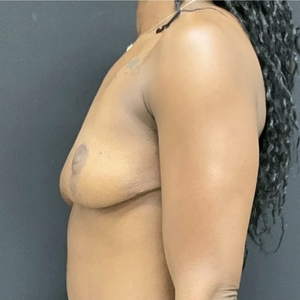 Breast Lift #10-after