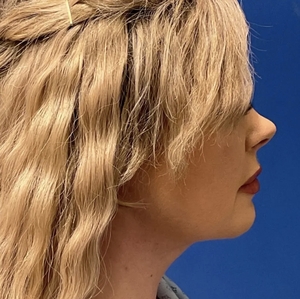 Lipo w Renuvion Face #2 (right)-after