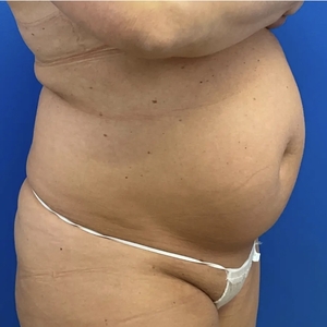 Lipo w Renuvion #3-before