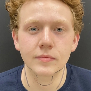 Lipo w Skin Tightening Face #6-before