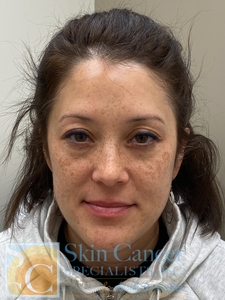 IPL Face 1 Treatment-before