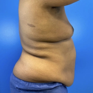 Male Breast Reduction #1-before