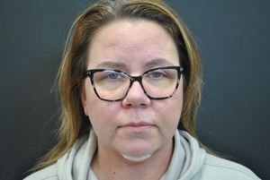 FaceTite & Liposuction 12 Days Front View-after