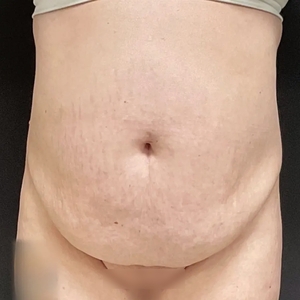 Tummy Tuck #11-before