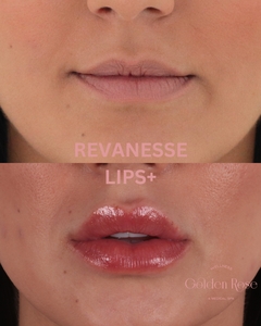 Lip Fillers-before