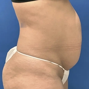 Lipo w Renuvion #5-before