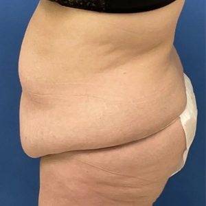 Tummy Tuck #1-before
