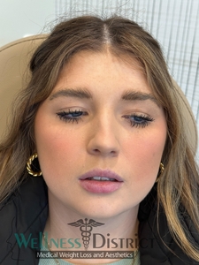 Before and three weeks healed-after