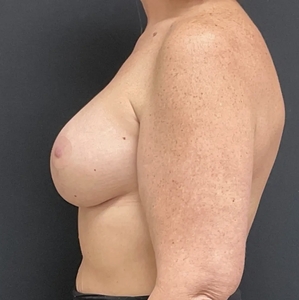 Breast Augmentation #22 350/410 cc-after
