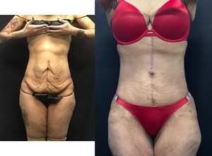 Tummy Tuck w/ Fluer de lis scar-before
