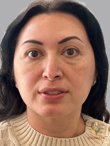 Cellenis Derma PRP 11ML-after