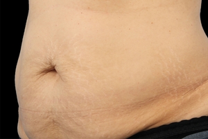 4 Treatments-after