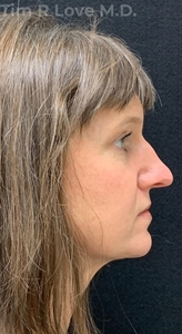 Rhinoplasty - Traditional-before