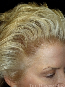 5 months post op-after