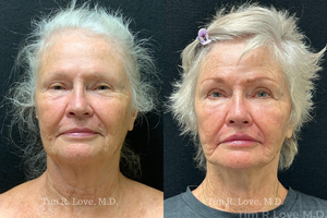1 year post op short scar face lift and upper lip lift, MyEllevate, Facetite, Morpheus8 x2, Sculptra-before