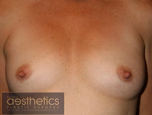 Mentor Smooth Round Saline: R385cc L380cc-before