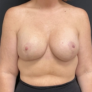 Breast Lift #13 (front)-after