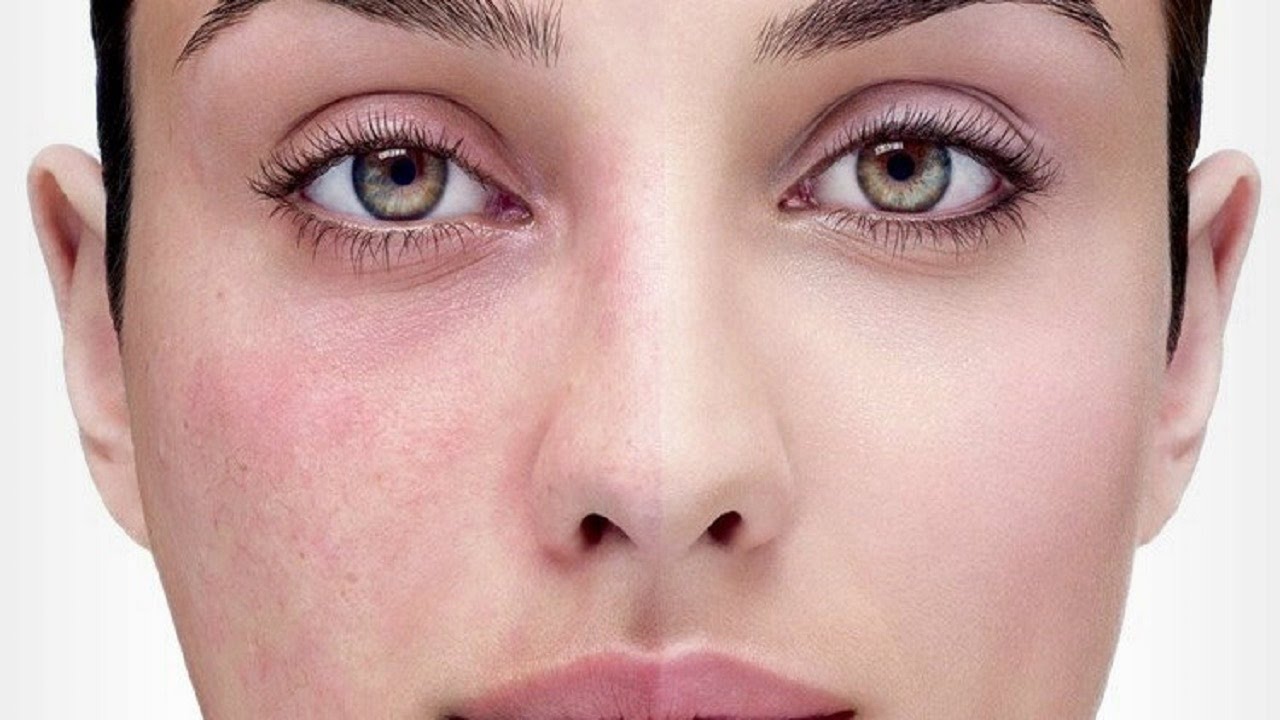 Redness and Vascular Treatments