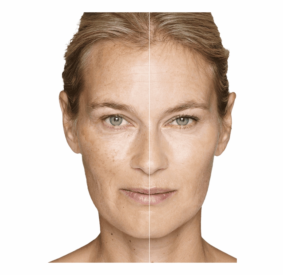 Resurfacing Treatments