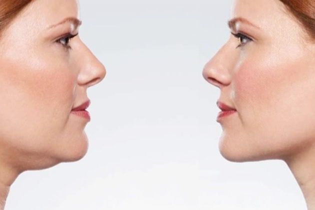 Kybella