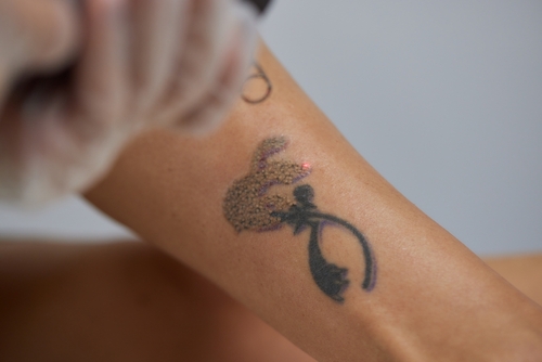 Laser Tattoo Removal