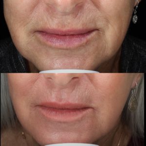 Laser Skin Resurfacing