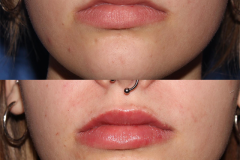 Lip Fillers