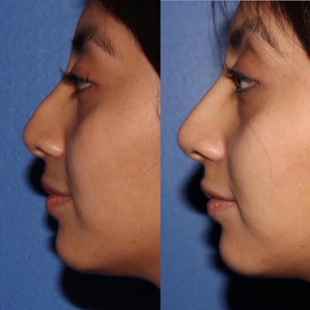 Non-Surgical Nose Jobs