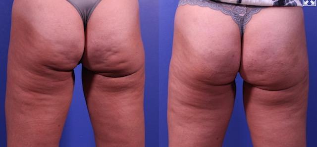 Cellulite Treatments