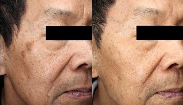 Revlite Laser Facial