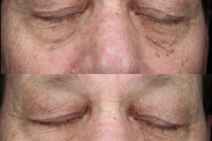 Sciton Spot Treatment