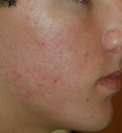 Acne & Acne Scars