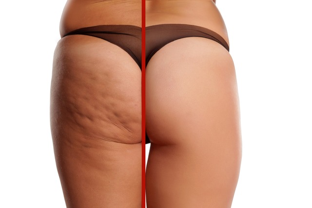 Avelli Cellulite Treatment