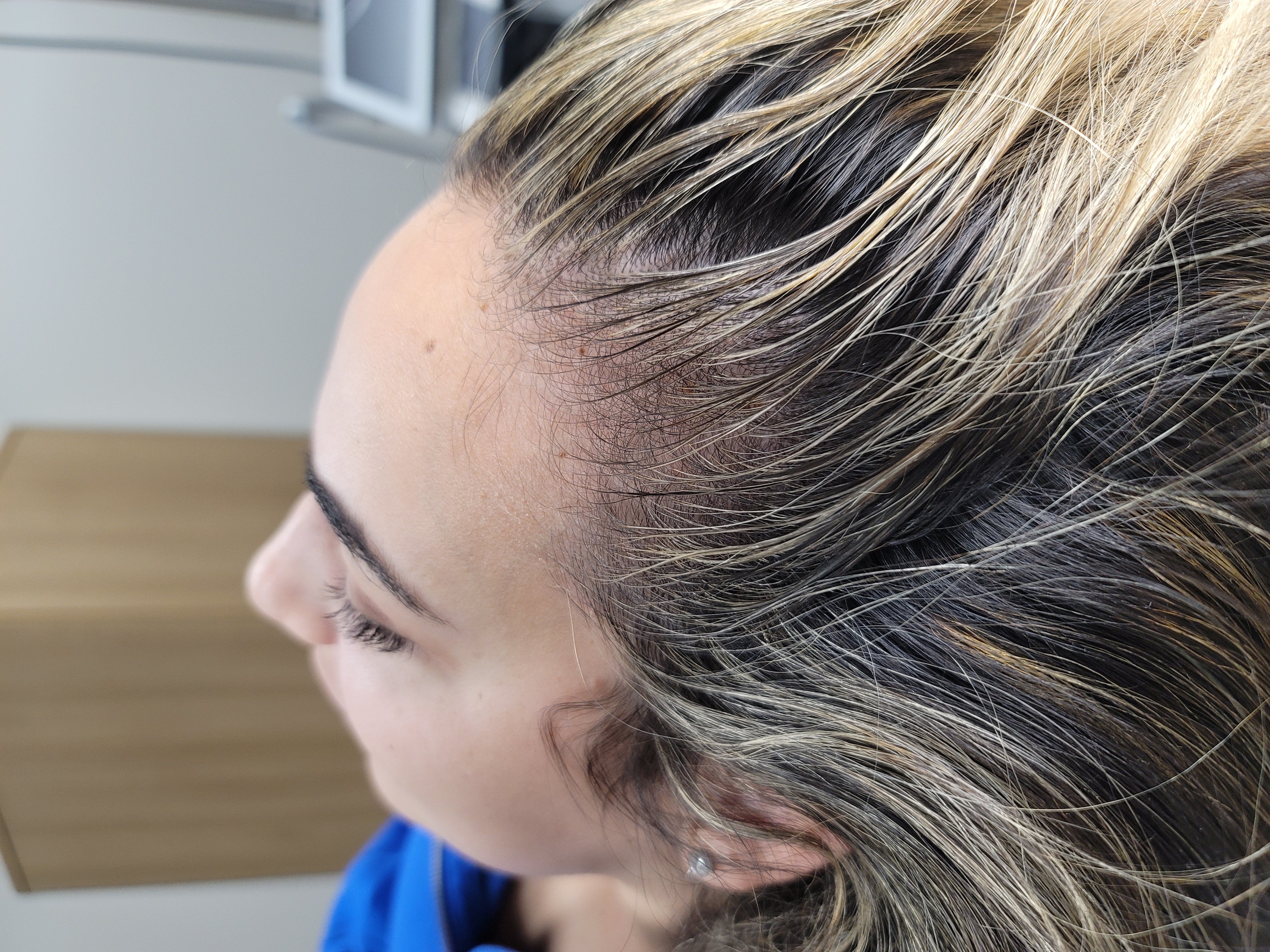 10 weeks after post 1st Treatment-before