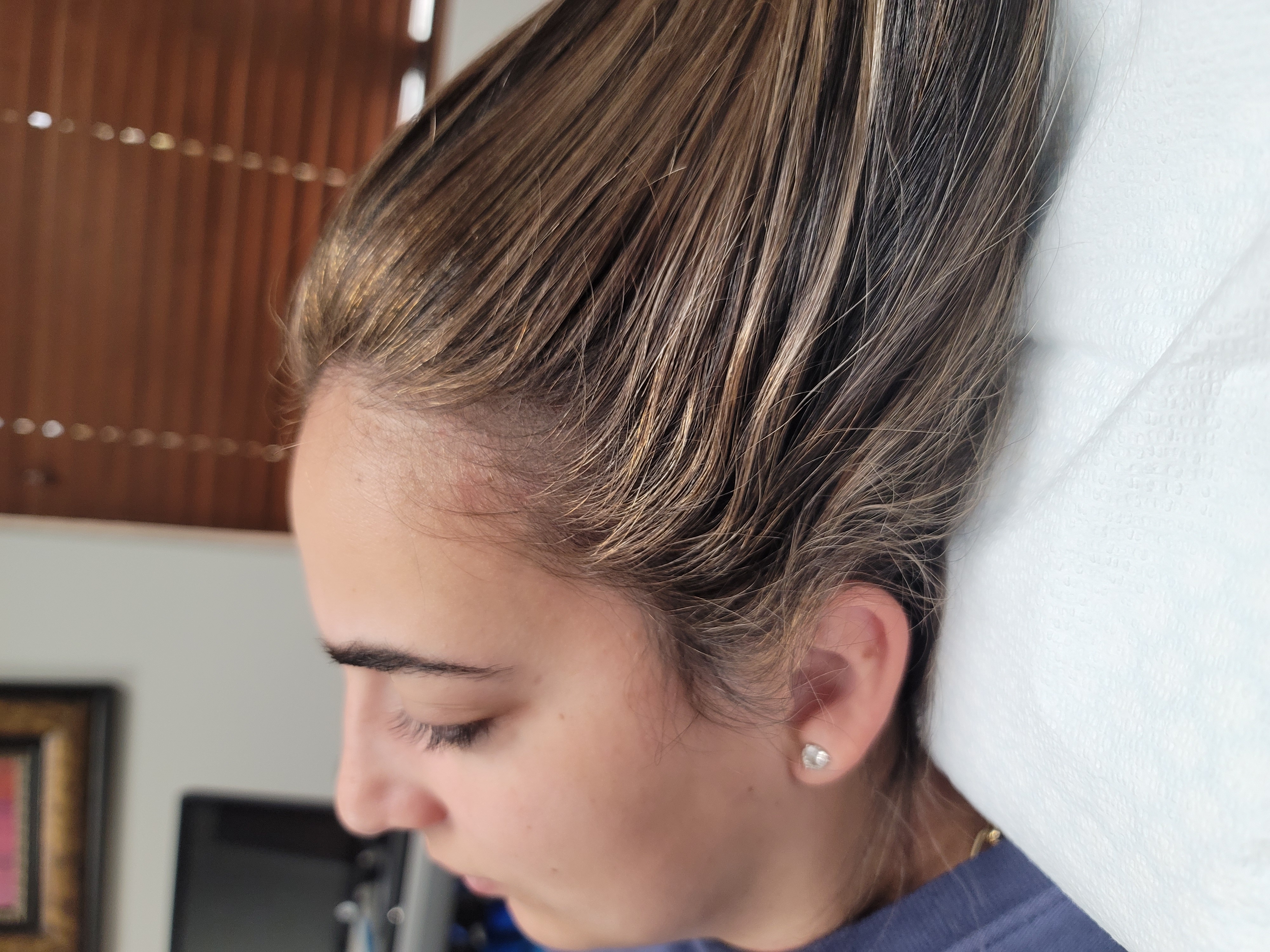 10 weeks after post 1st Treatment-after