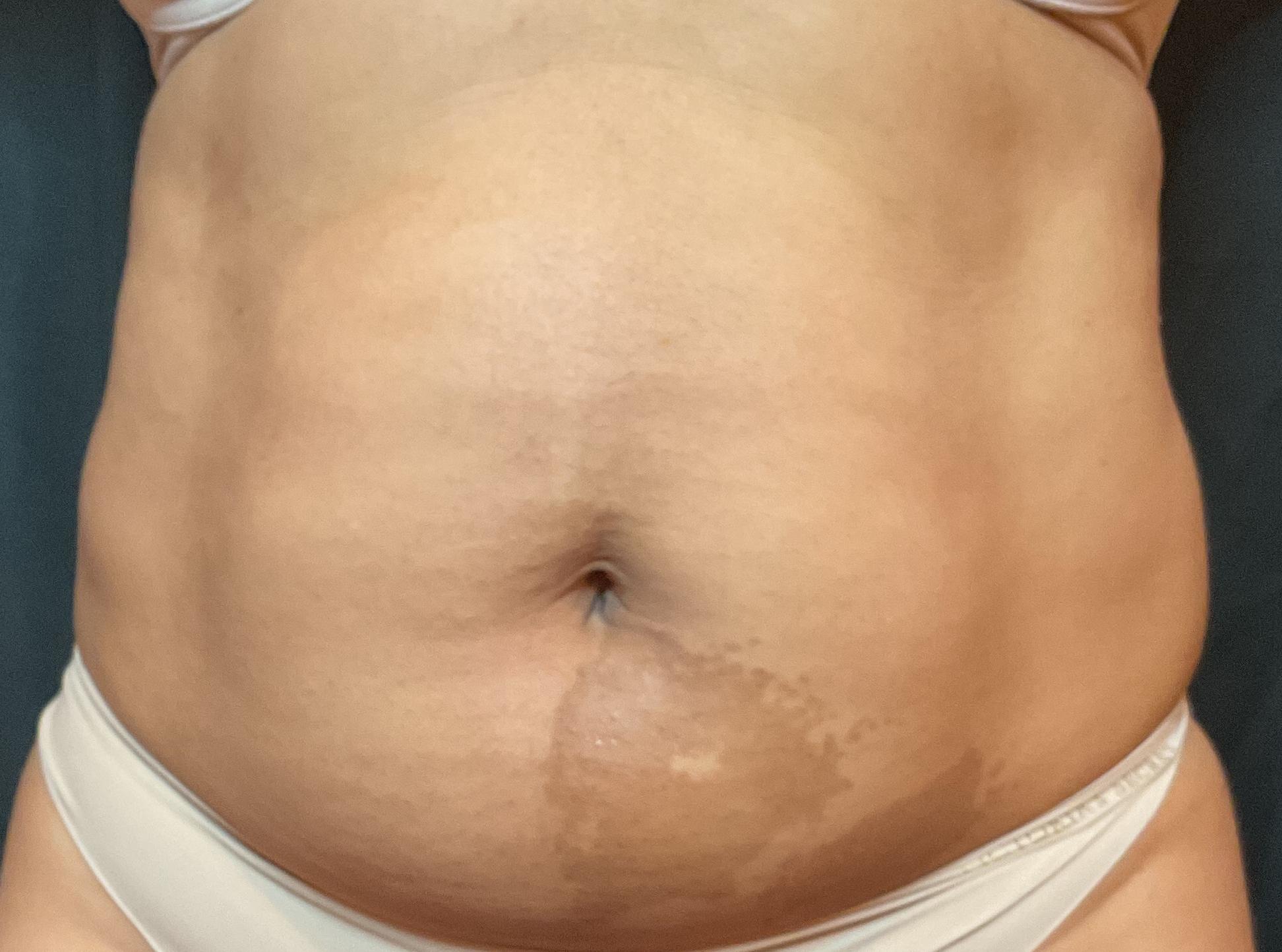 After 8 Treatments-before