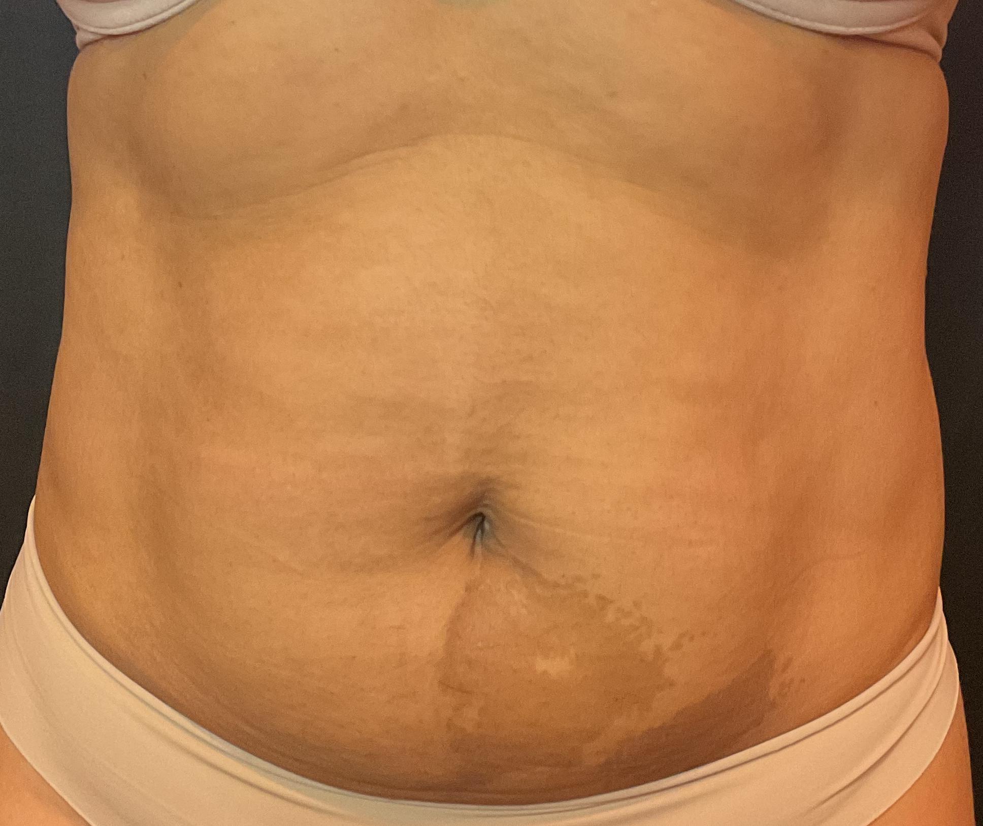 After 8 Treatments-after