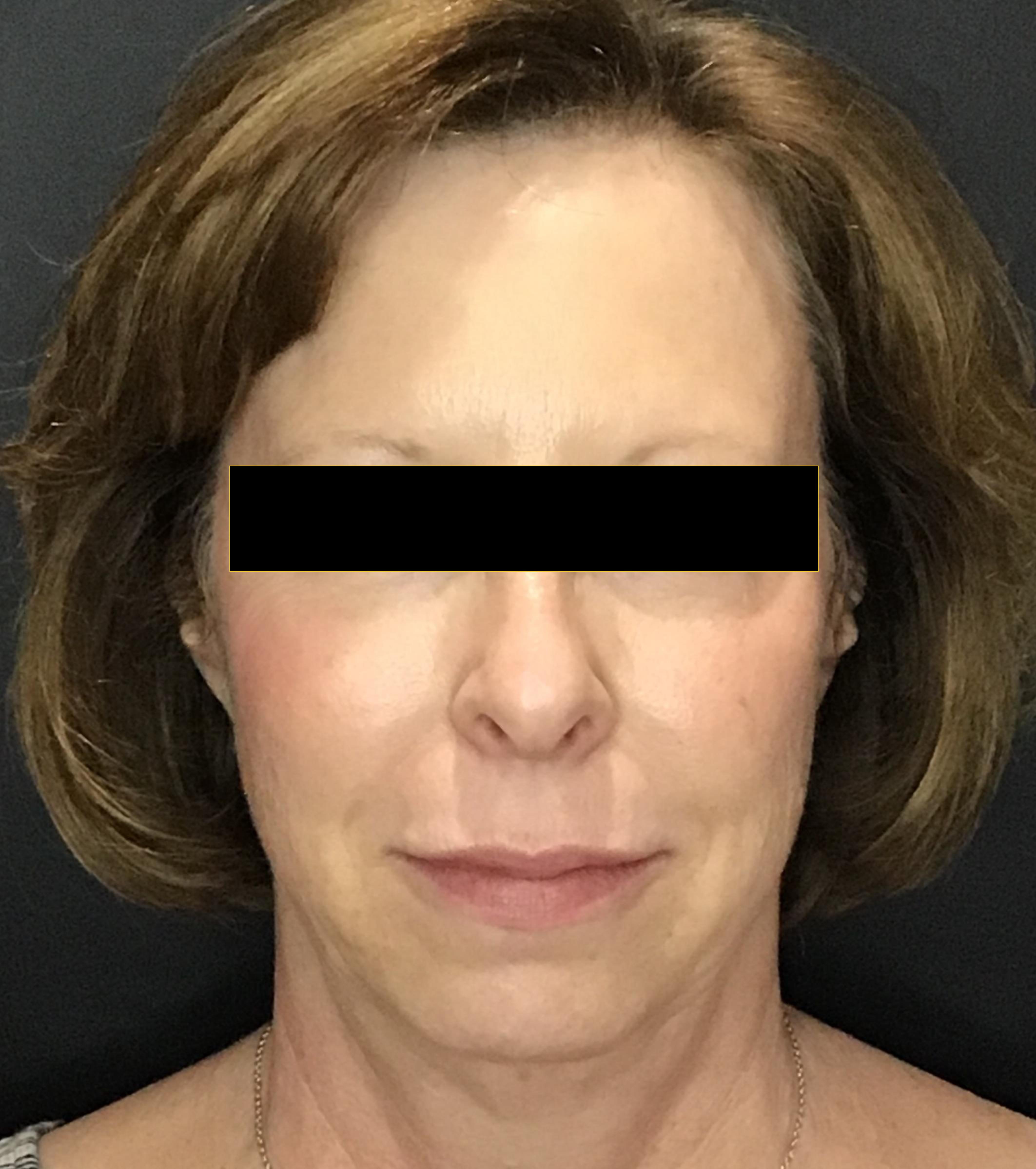 Juvéderm & Plasma Pen Combination Treatment-after