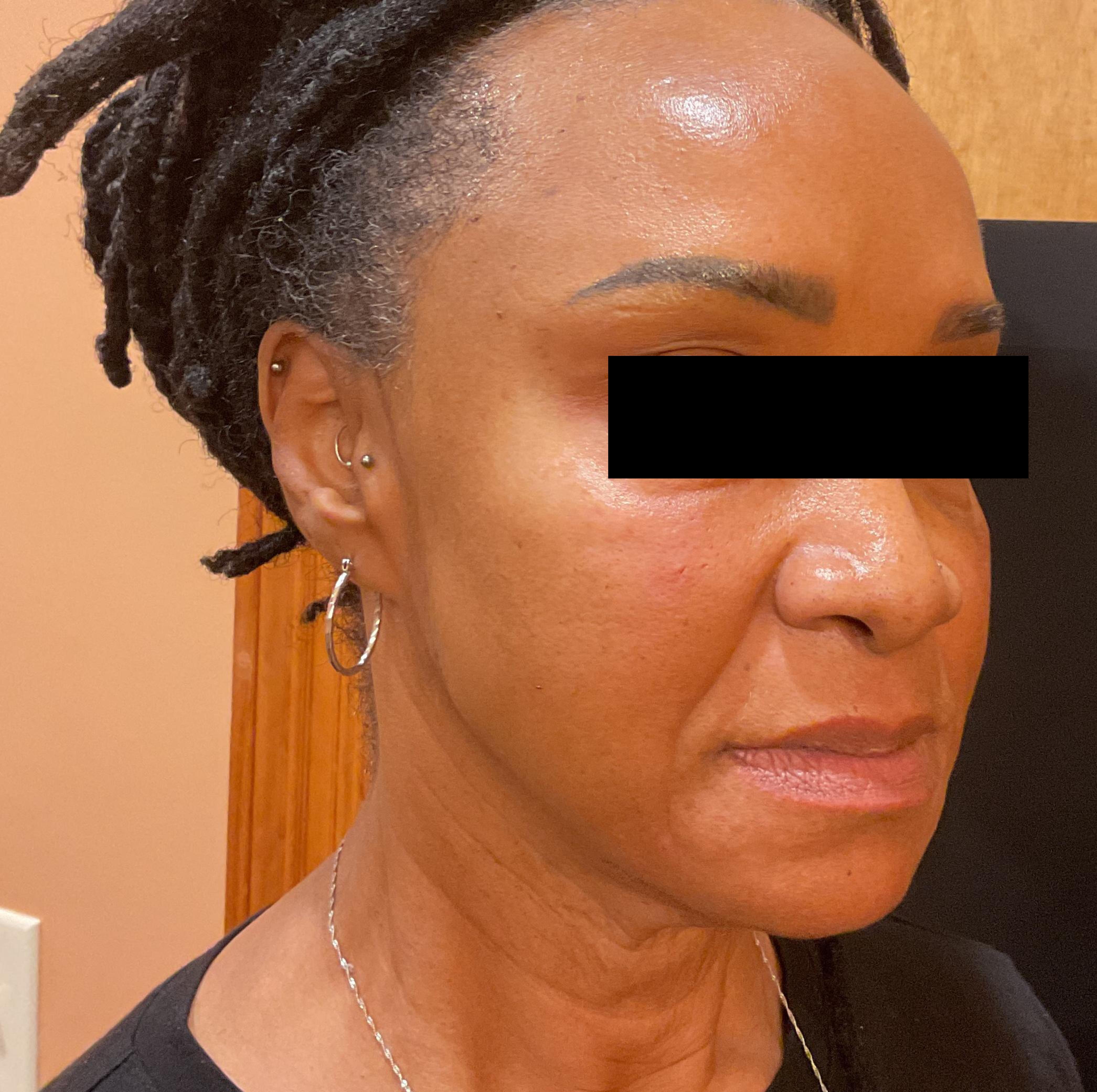 Nasolabial Folds & Cheeks-after