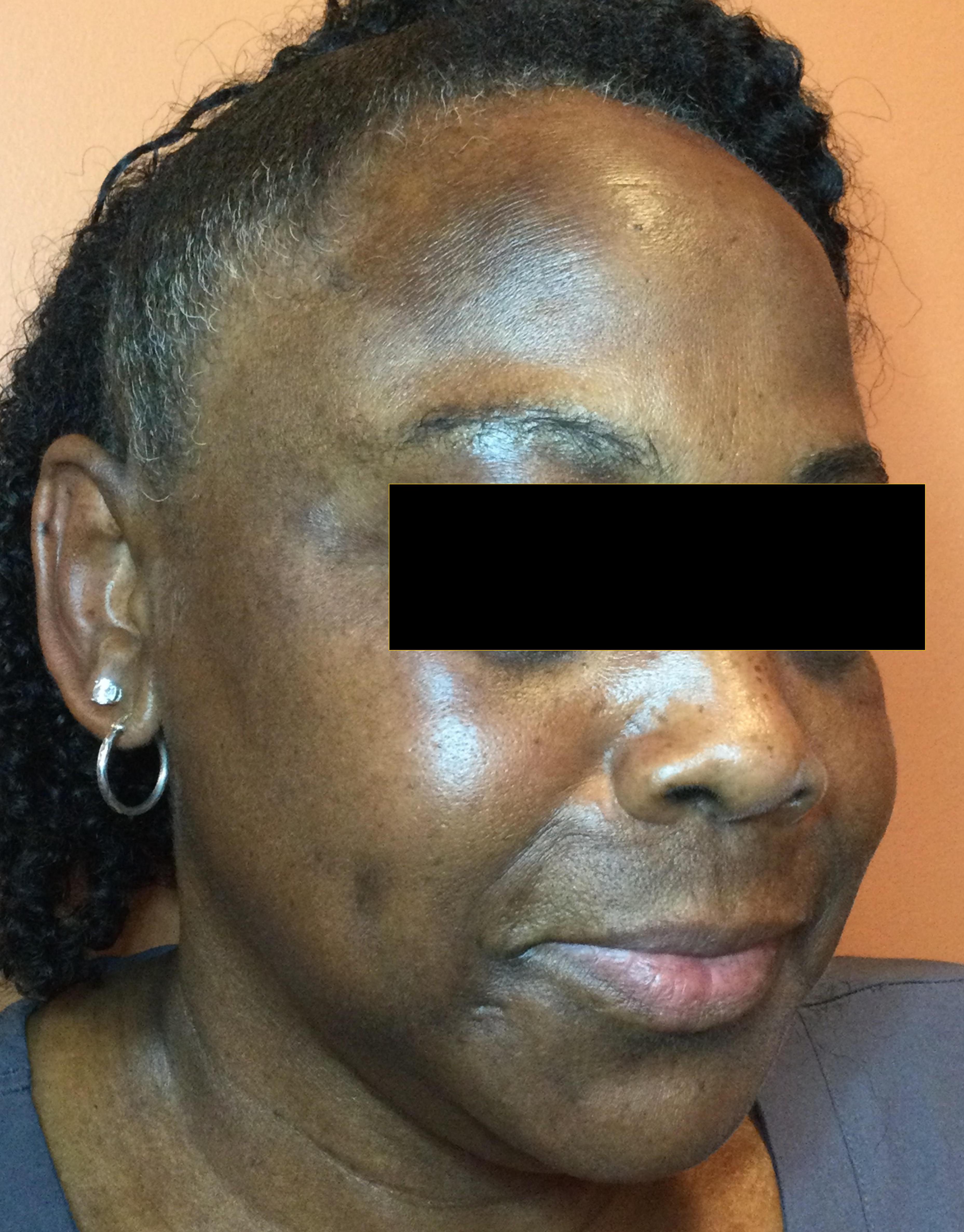NeoSkin w/ ChemPeel for Hyperpigmentation-before