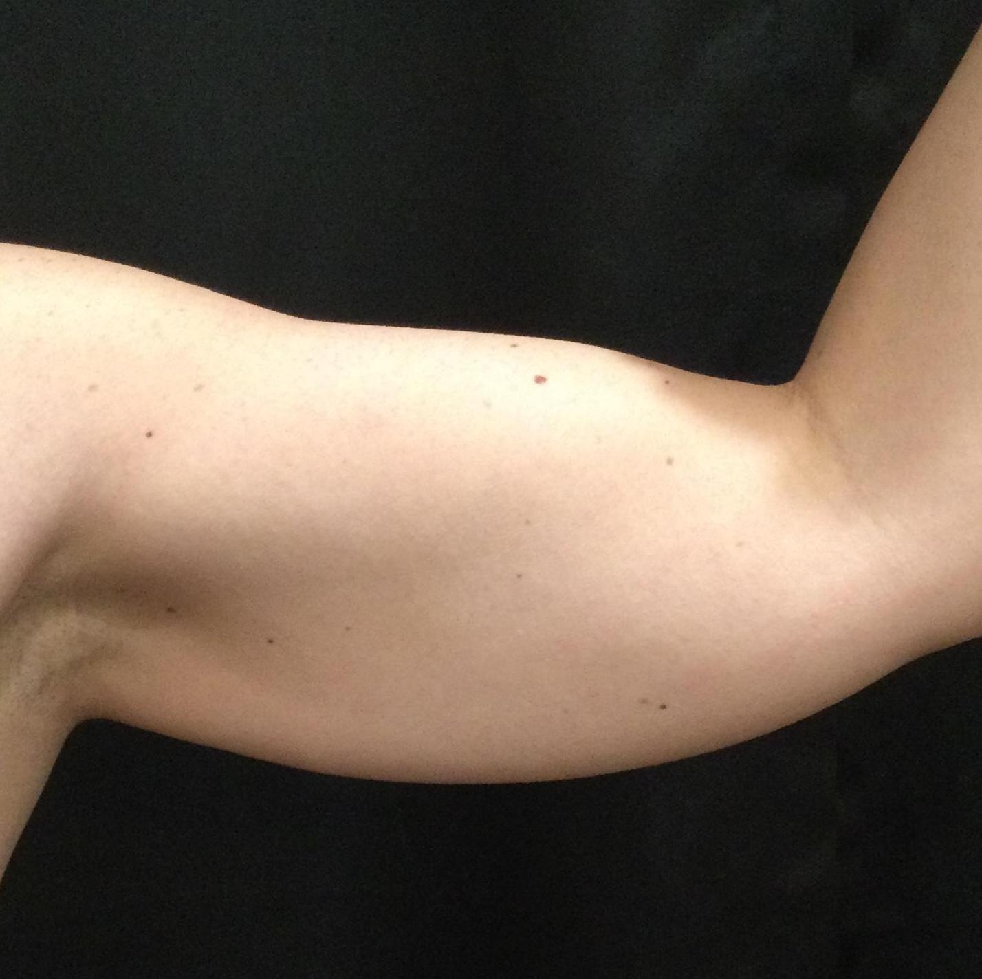 After 3 months (2 Treatments)-before