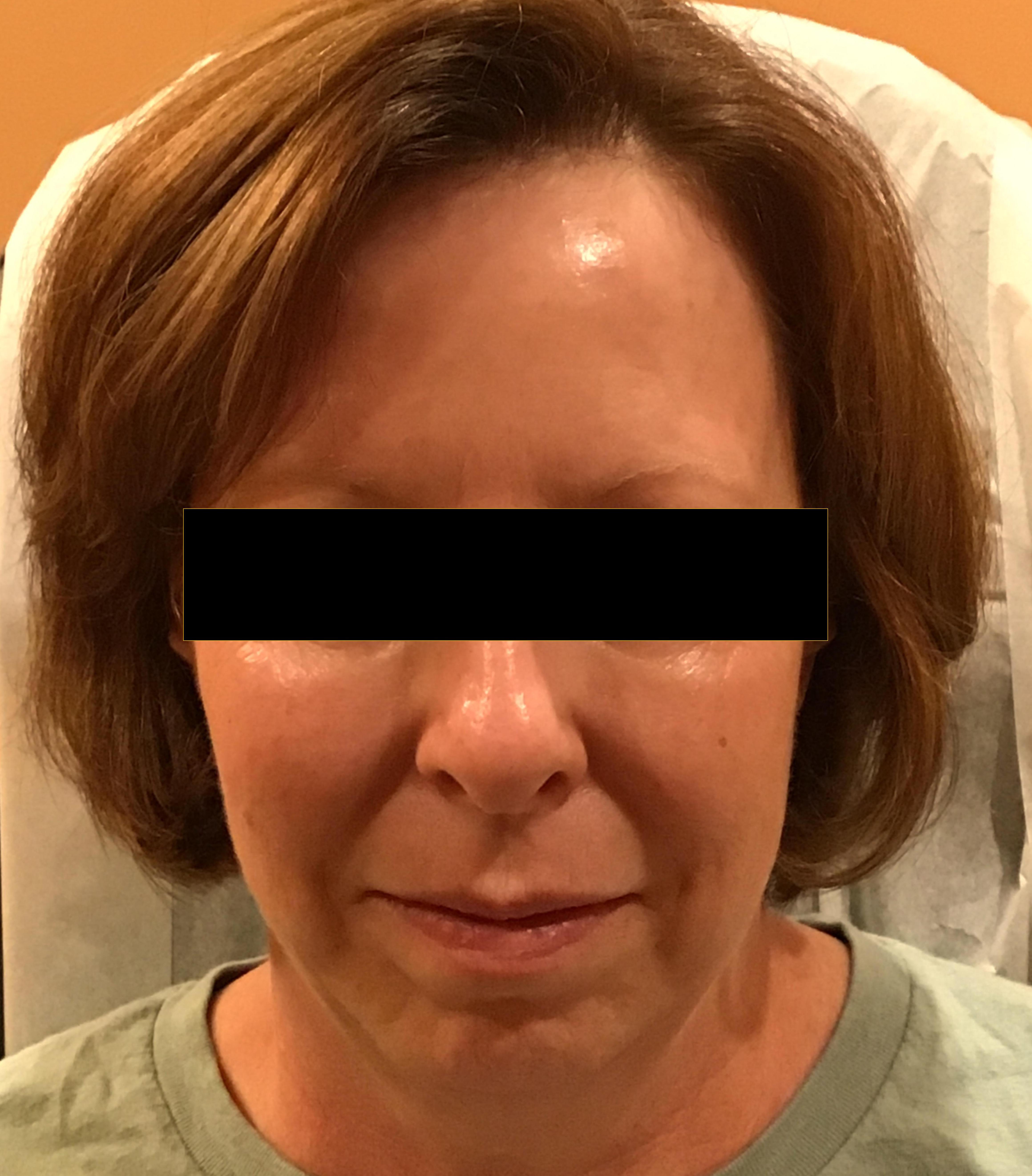 Juvéderm & Plasma Pen Combination Treatment-before