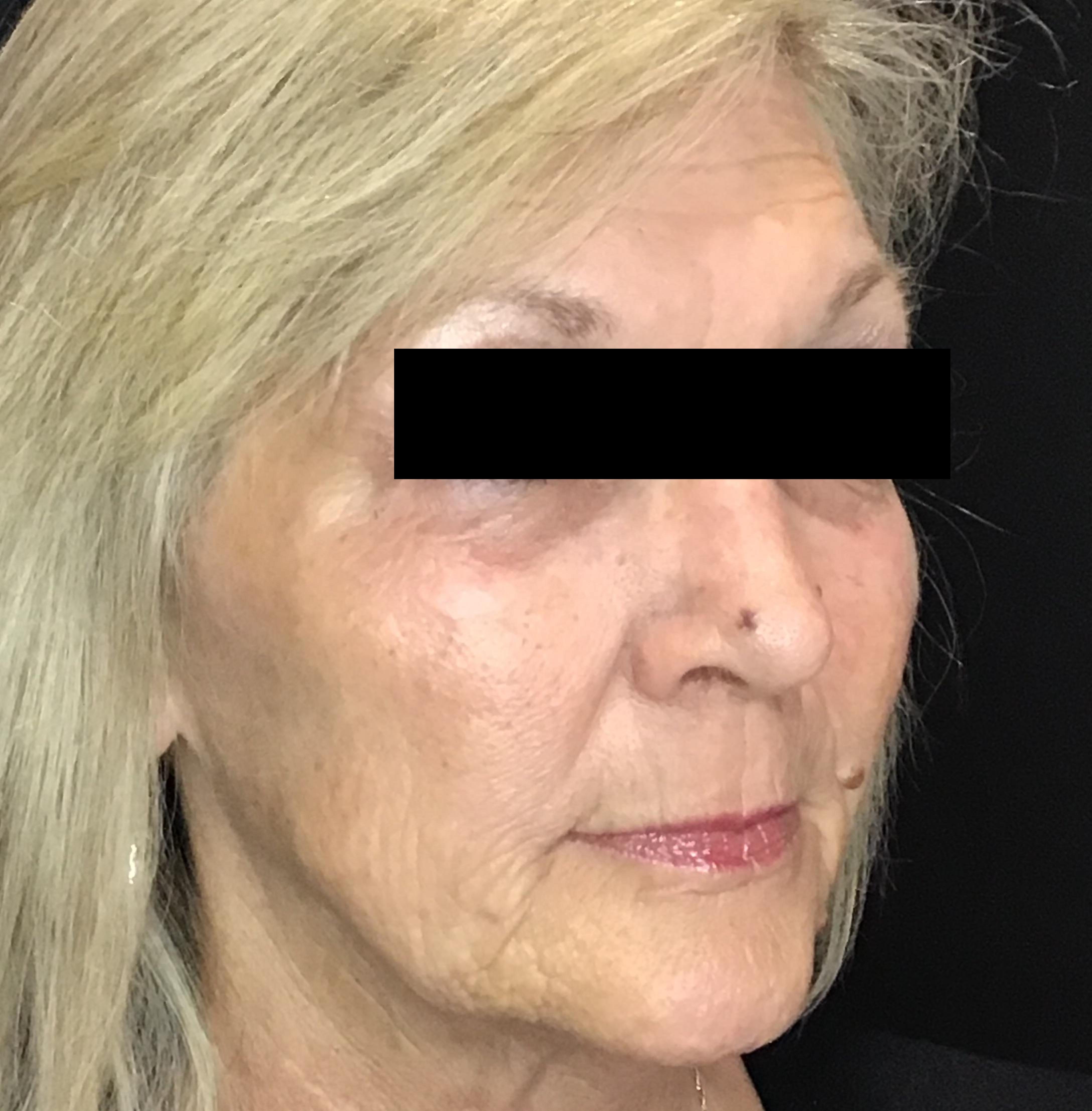 Juvéderm & Plasma Pen Combination-after