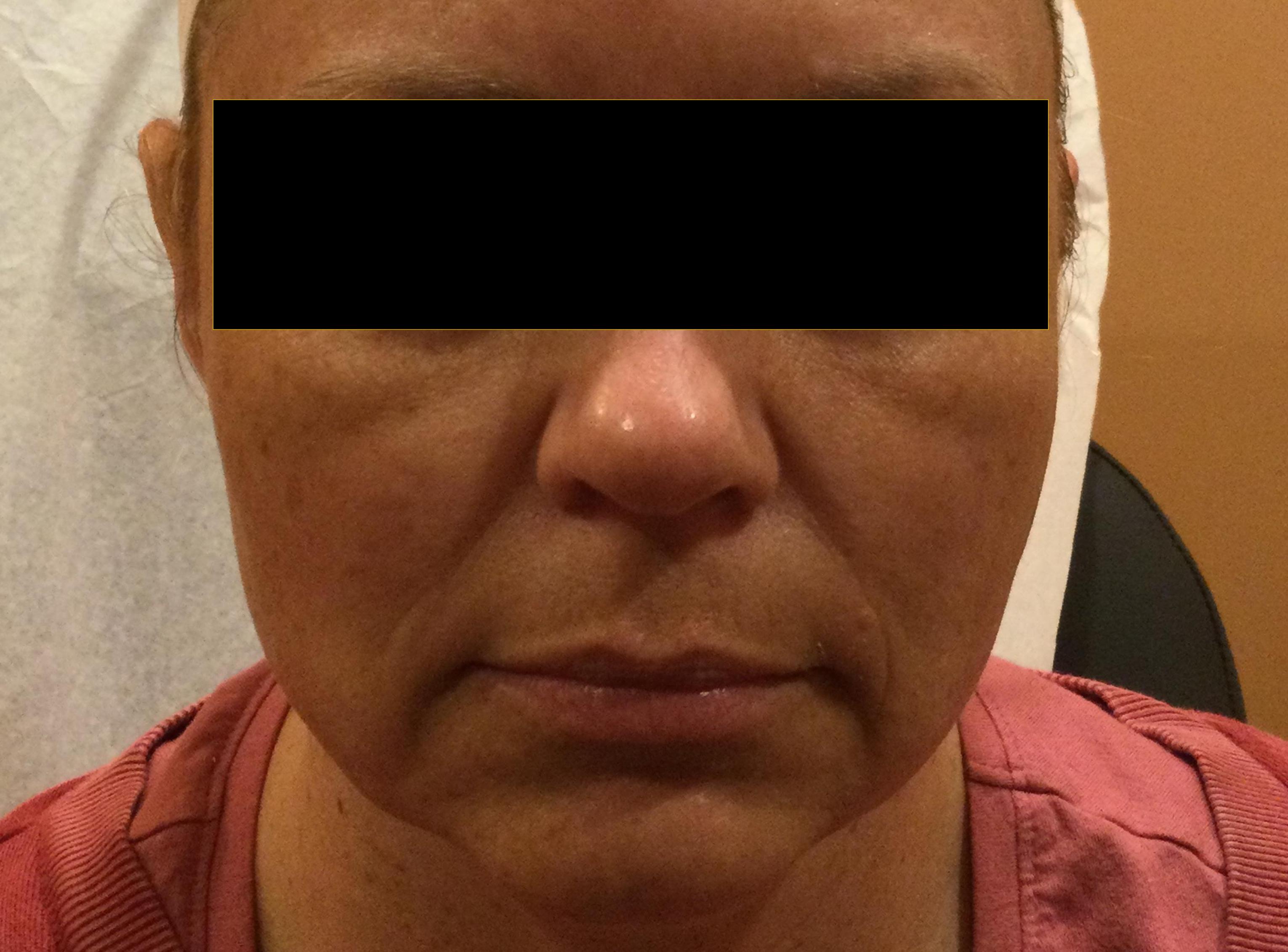 Cheeks, Jawline & Lips-before